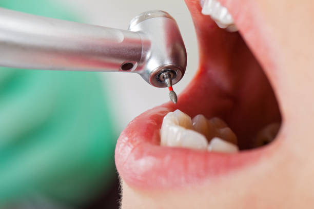 Best Emergency Treatment for Dental Infections or Abscesses in Gluckstadt, MS